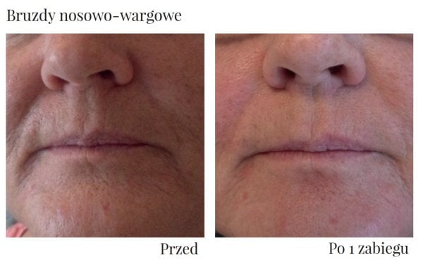 Tak wygląda usunięcie brózd