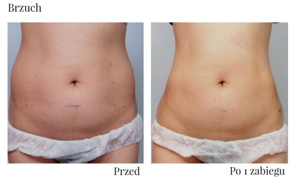 Tak wygląda brzuch przed i po zabiegu hifu