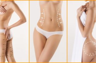 Zabieg liposukcji i lipotransferu doskonały do polepszenia wyglądu.